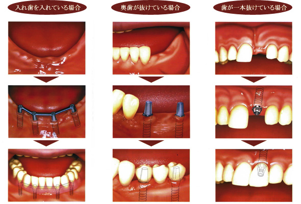 インプラント治療の一例です