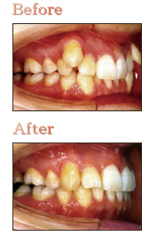 八重歯の治療例