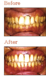 歯周矯正の治療例